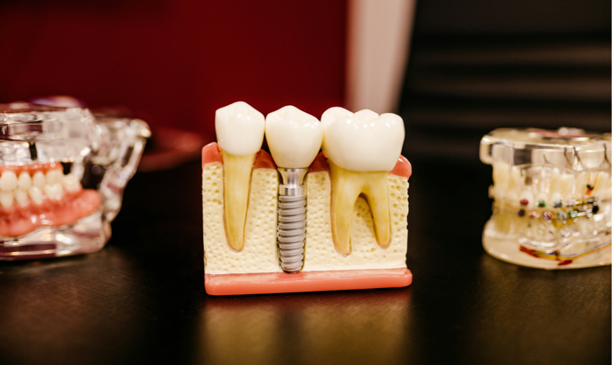 5 Ways Dental Implants Can Improve Your Quality of Life